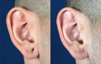 Ear stretching – how big is too big 